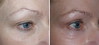 eyelid-surgery-7-017 3