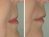 lip-implant-1-032 12
