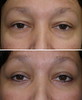 eyelid-surgery-4-031 2