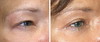 eyelid-surgery-7-022 4