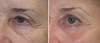 eyelid-surgery-4-015 5