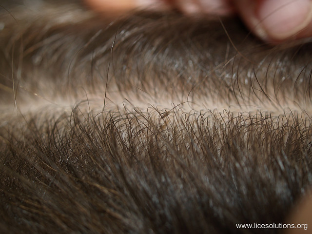 Head Lice - Louse in Hair