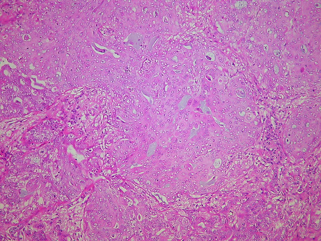 Adenocarcinoma, solid with mucin production subtype