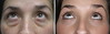 eyelid-surgery-6-049 1