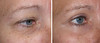 eyelid-surgery-1-024 4