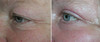 eyelid-surgery-2-106 7