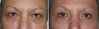 eyelid-surgery-4-043 14