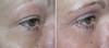 eyelid-surgery-2-052 10