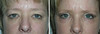 eyelid-surgery-2-108 9