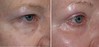 eyelid-surgery-4-029 0