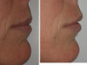 lip-implant-1-053 15