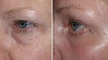 eyelid-surgery-1-022 2