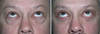eyelid-surgery-1-039 18