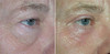 eyelid-surgery-2-116 8