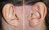 facelift-incisions-1-019 0