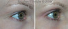 eyelid-surgery-2-084 12