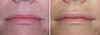 lip-implant-1-028 8
