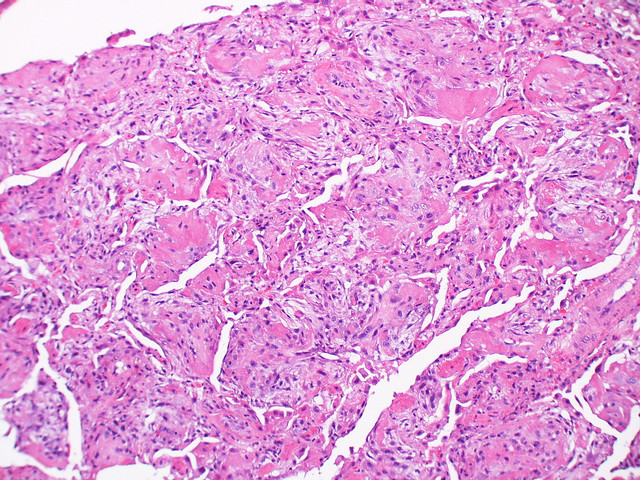 Acute fibrinous & organizing pneumonia (AFOP)  Case 123