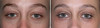 eyelid-surgery-3-010 0