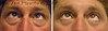 eyelid-surgery-1-072 16