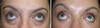 eyelid-surgery-5-025 4