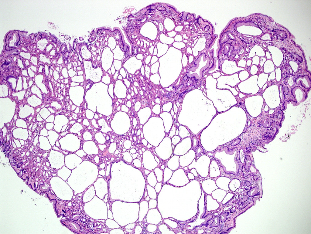 Qiao's Pathology: Fundic gland polyp
