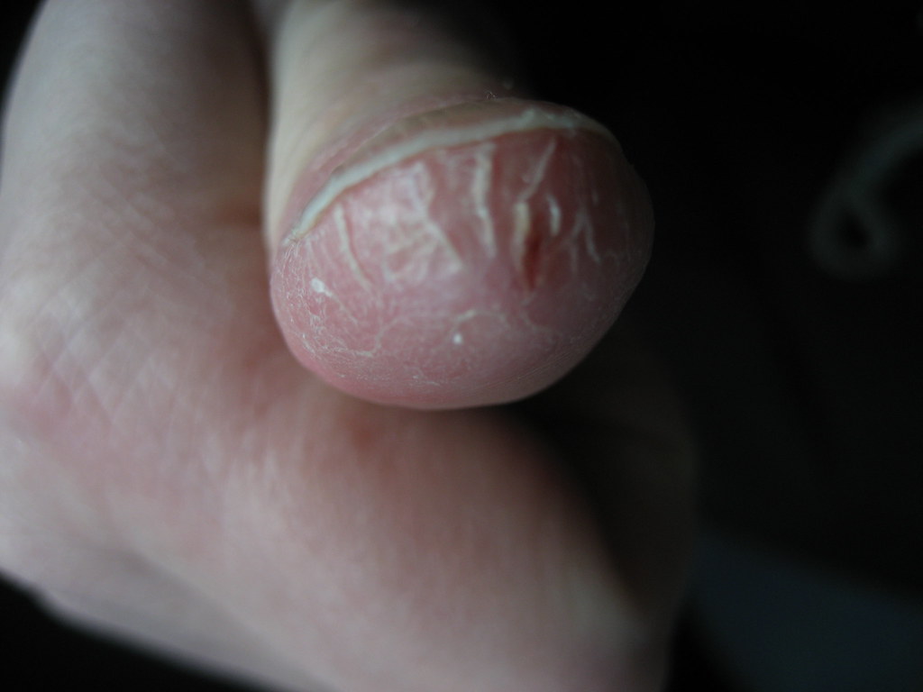 OUCH ! - Dry cracked skin around thumb | This happens to me … | Flickr