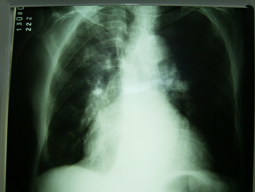 Cancer de pulmão