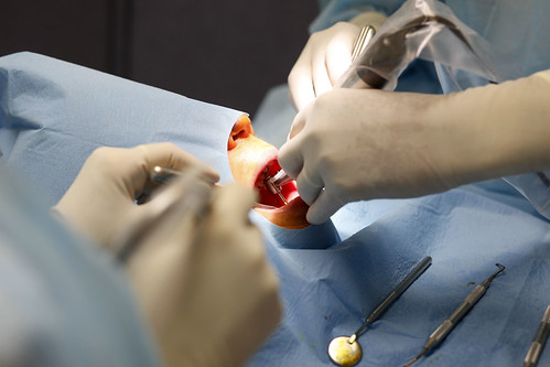 chirurgie implantaire 031 | by Dr Luc Sebaoun