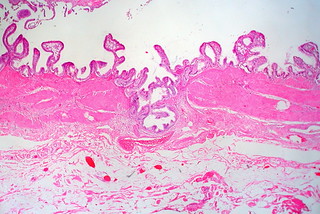 Rokitansky-Aschoff Sinus, Gallbladder