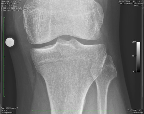 Knee x-ray 1 | by cloggyspete