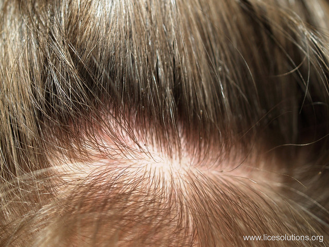Head Lice - Nits on Hair