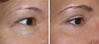 eyelid-surgery-3-017 15
