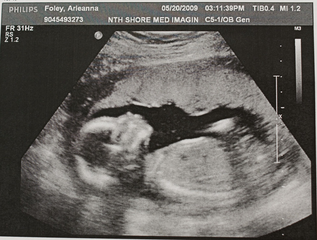 18 недель мальчик. Снимок УЗИ на 19 неделе беременности. УЗИ 19 недель беременности. 18 Недель беременности фото плода на УЗИ. УЗИ 18 недель беременности.