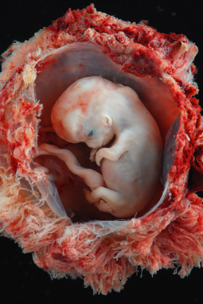Embryo @ approximately 8 weeks from conception, 10 weeks estimated gestational age from LMP.