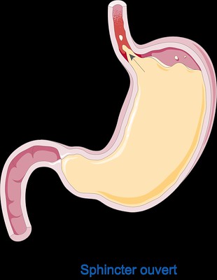 Reflux Gastro-Oesophagien 2