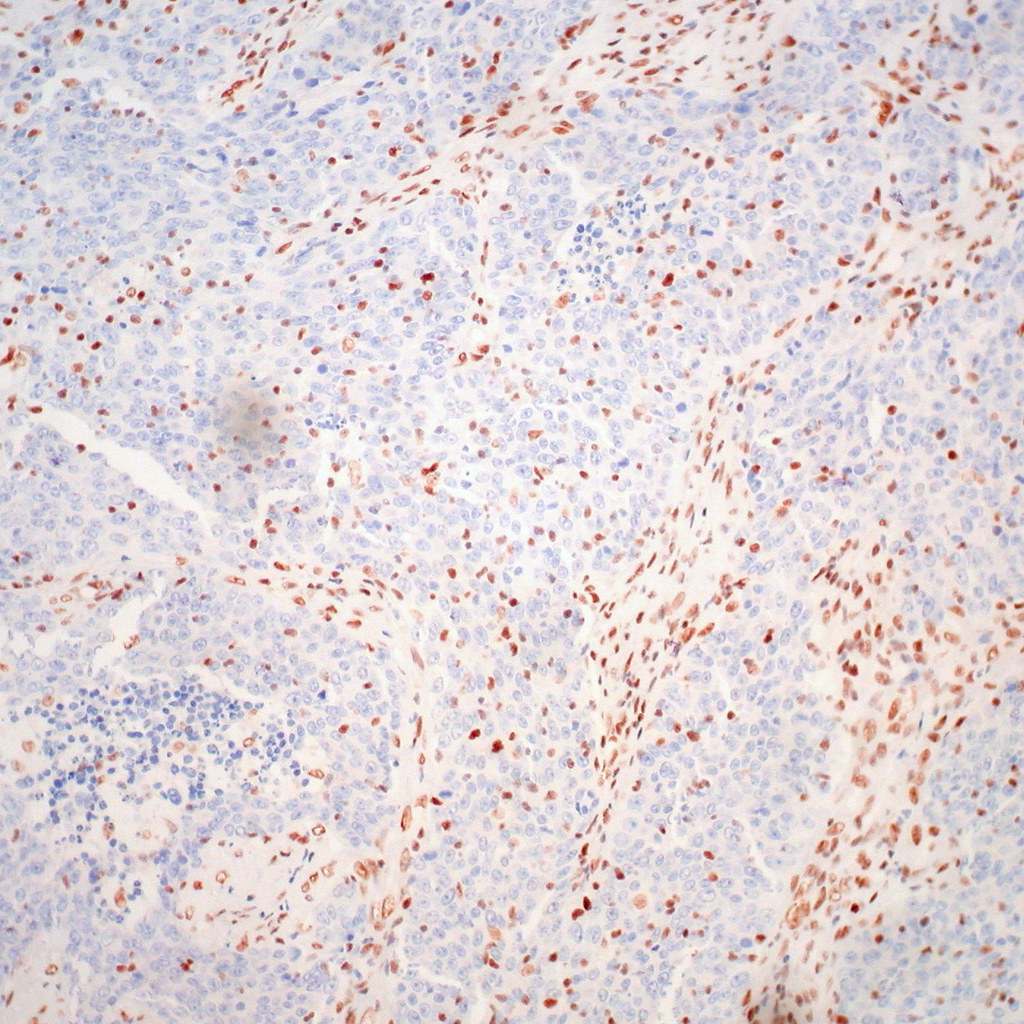 Medullary Carcinoma of the Colon, hMLH-1