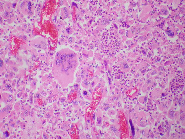 Giant cell carcinoma - Case 284