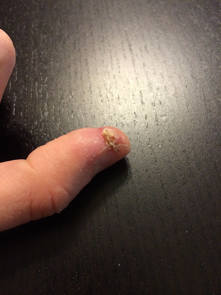 Frankenthumb