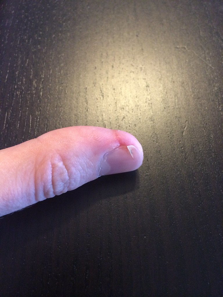Frankenthumb