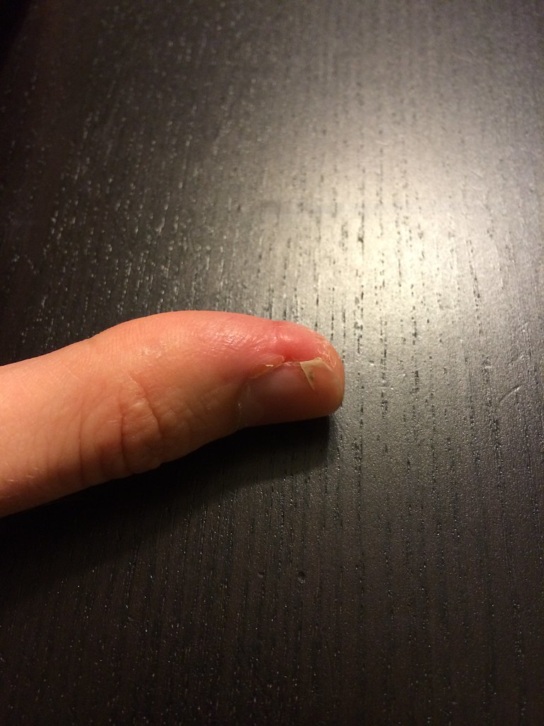 Frankenthumb