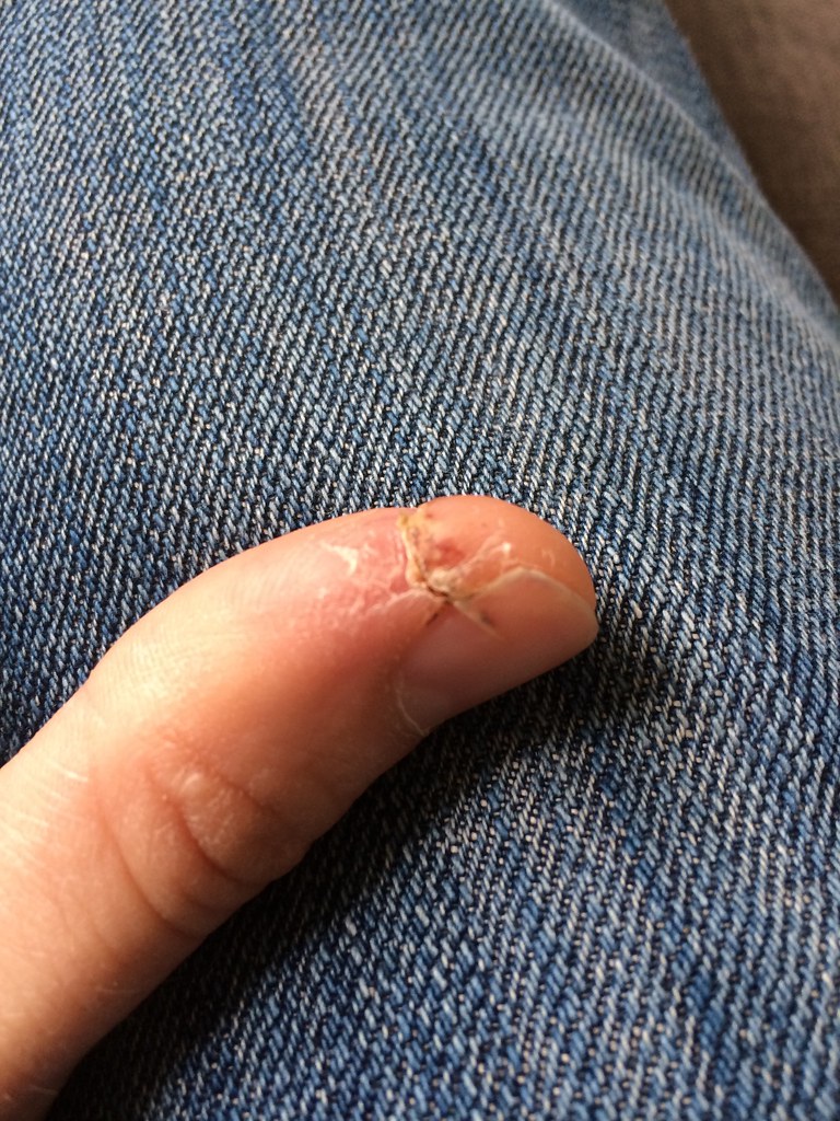Frankenthumb