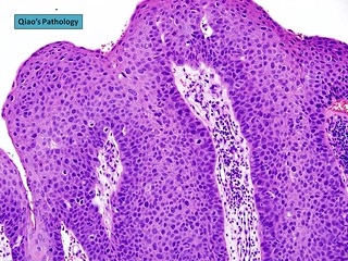 laryngeal papilloma dysplasia