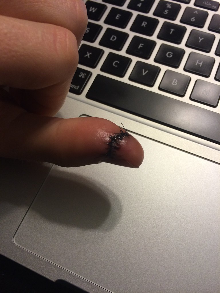 Frankenthumb