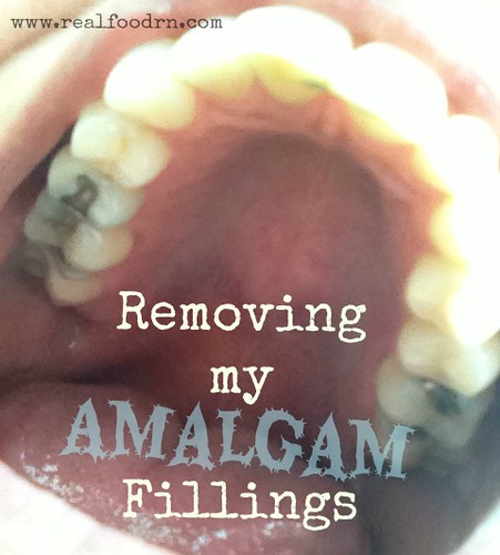 Removing my Amalgam Fillings