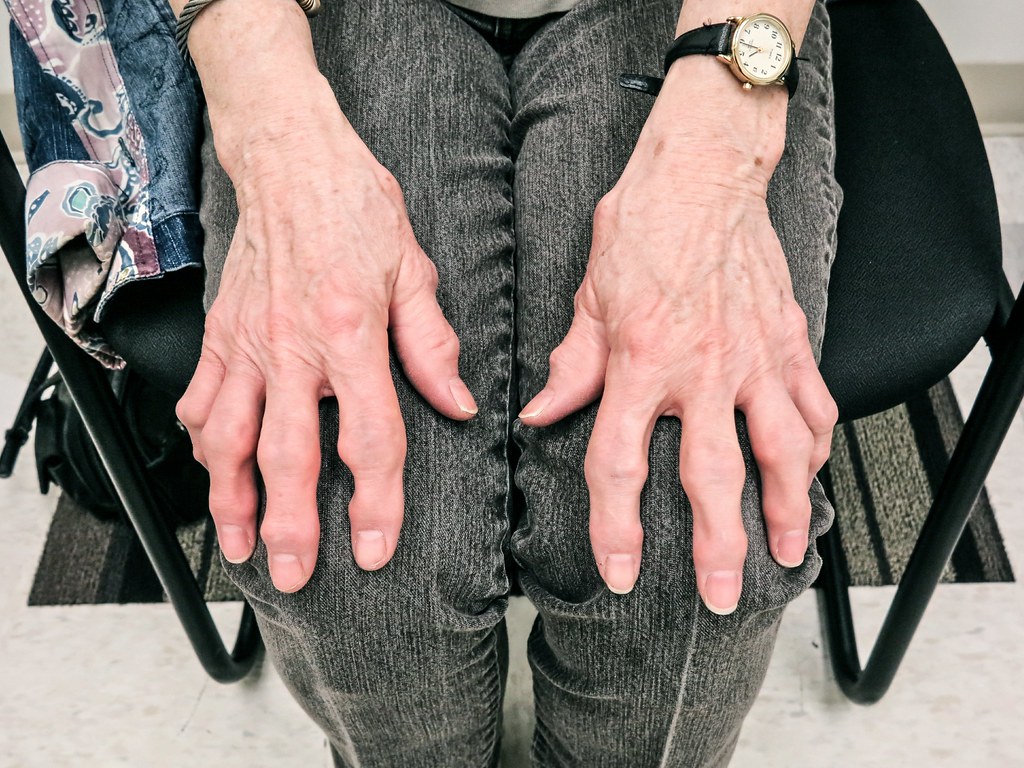 Руки бомжа. Деформирующий ревматоидный артрит.