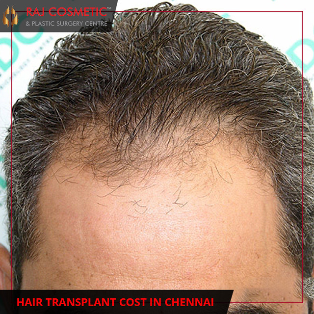 hair transplant cost in chennai | Hair Transplant in Chennai… | Flickr