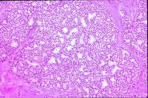 Typical carcinoid, follicular pattern | Atlas of Pulmonary Pathology ...