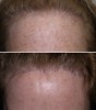browlift-hairlines-1-007 6