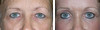 eyelid-surgery-1-047 7